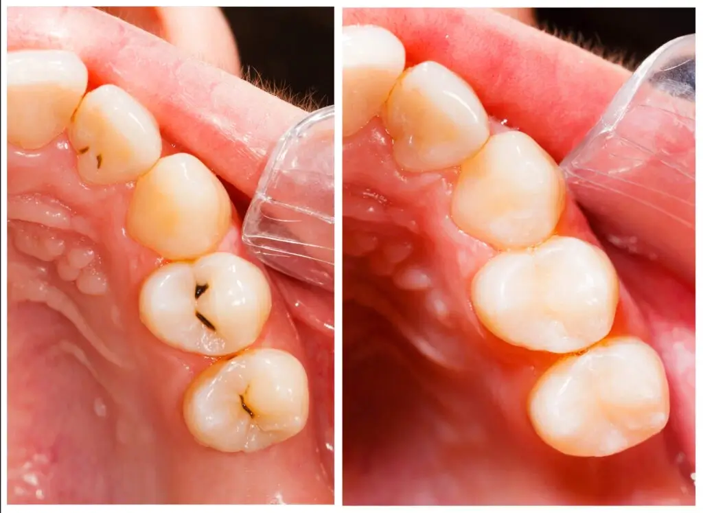 before and after: Tooth Fillings Auburn AL