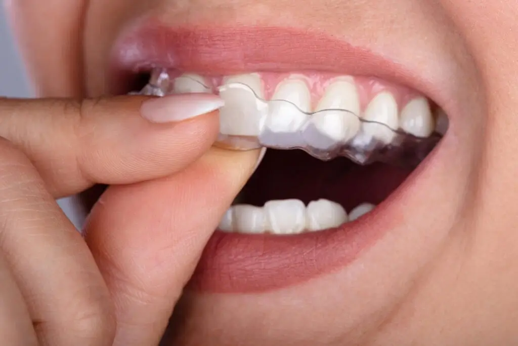patient smiling and wearing clear aligners auburn