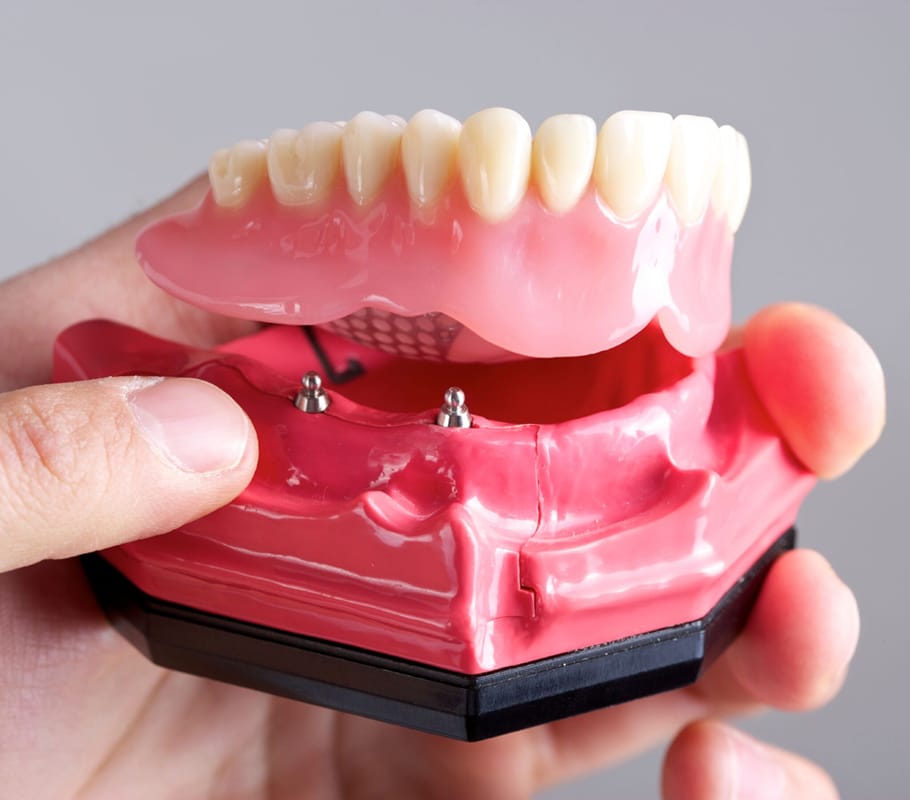 Transform Your Smile with Secure Denture Solutions